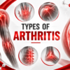 Types of Arthritis